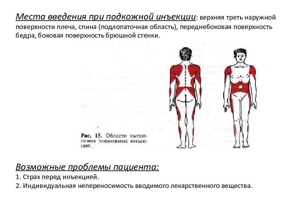 Отметьте на рисунке и напишите места для внутримышечных инъекций 6 мест