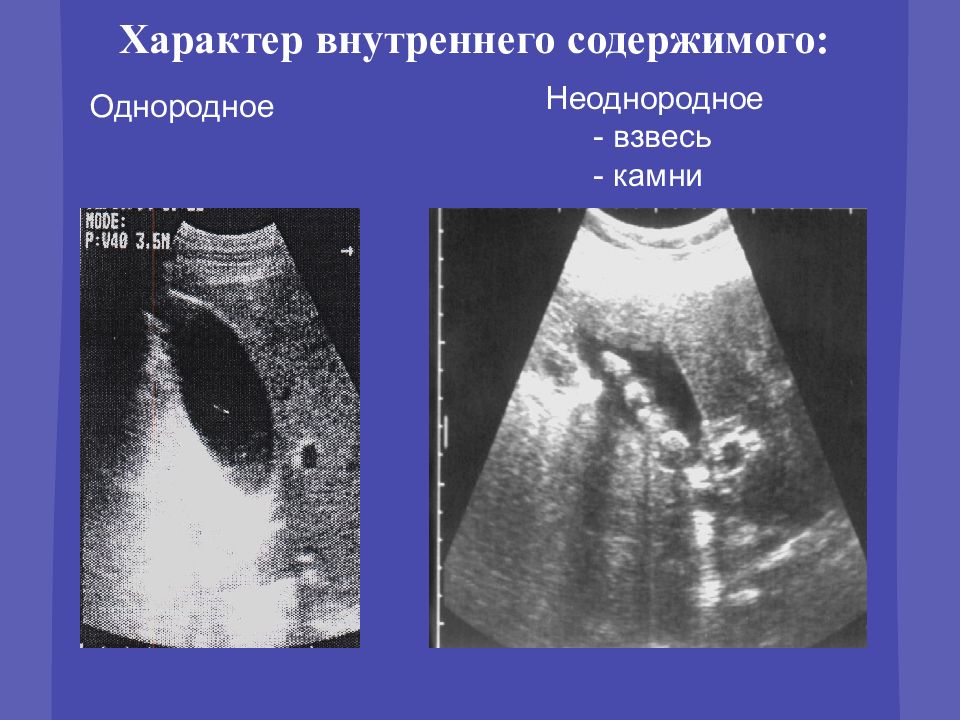 Полость матки расширена с анэхогенным содержимым. Гомогенное содержимое кзи. Взвесь в Водах при беременности.