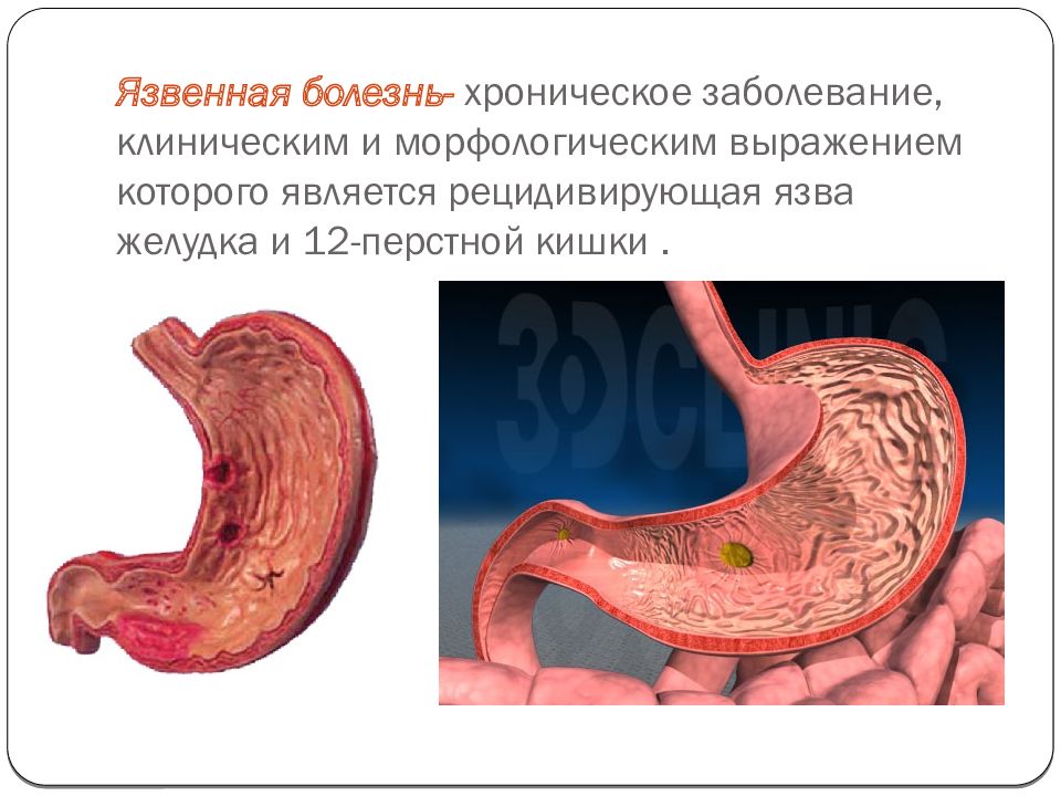 Орехи при язве желудка. Для язвенной болезни 12-перстной кишки характерно. Язвенная болезнь 12 перстной кишки клинические рекомендации. Язвенная болезнь это хроническое циклическое. Задачи 12 перстной кишки.
