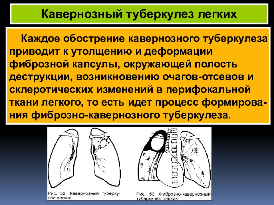 Кавернозный туберкулез. Кавернозный туберкулез легких схема. Острый кавернозный туберкулез. Фиброзно-кавернозный туберкулез легких патогенез.