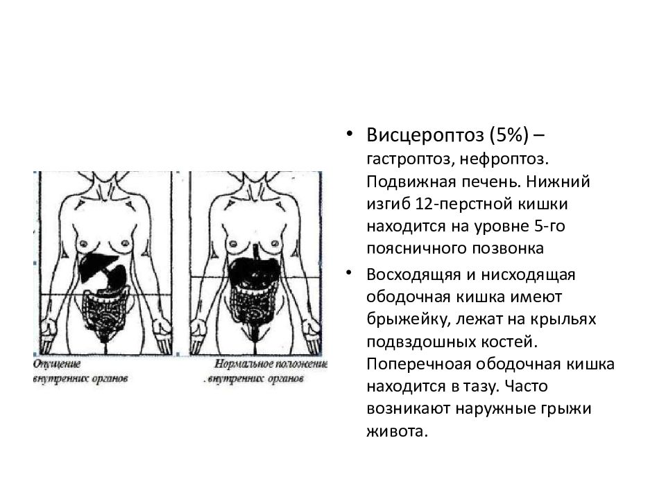 Опущение желудка. Опущение внутренних органов висцероптоз. Висцероптоз внутренних органов питание. Что такое спланхноптоз и висцероптоз. Опущение внутренних органов брюшной полости.