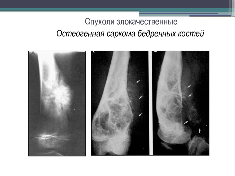 Опухоли костей схема