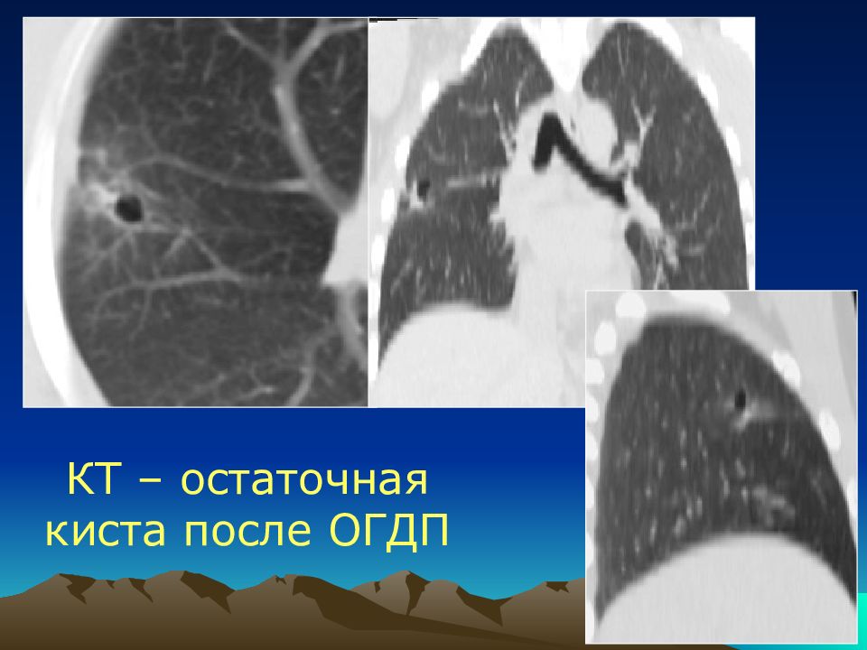 Резидуальная киста. Остаточная полость после кисты. Резидуальная киста образование.