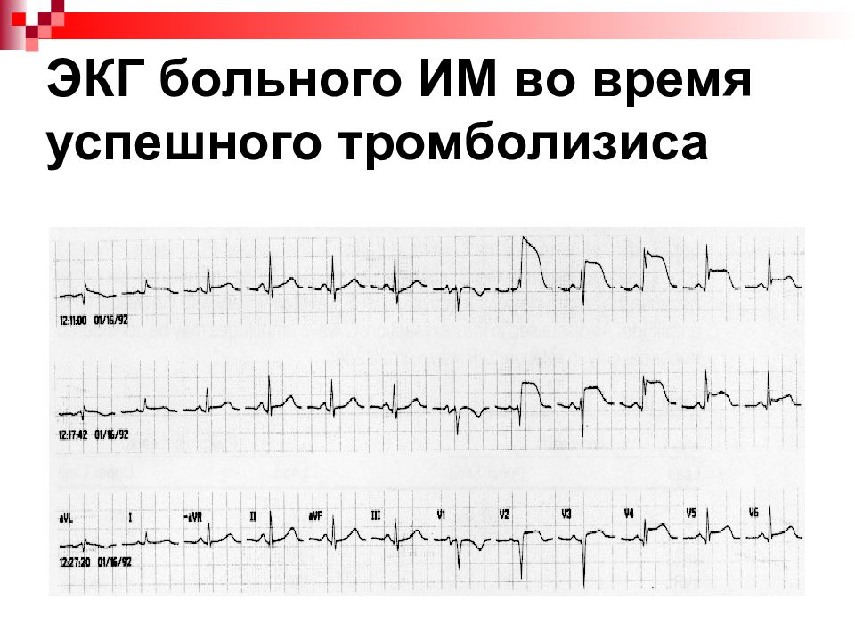 Пройти экг. Монофазная кривая при инфаркте миокарда. Периоды инфаркта миокарда на ЭКГ. Кардиограмма инфаркта возможного. Инфаркт на ЭКГ.