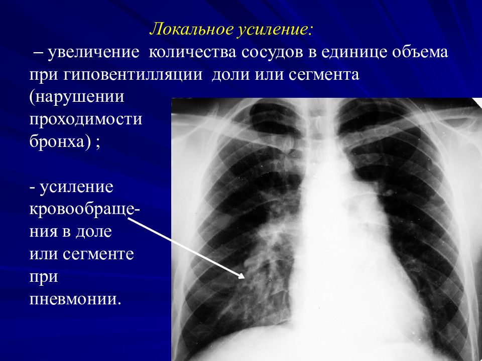 Усиление увеличение. Пневмония 7 сегмента. Пневмония в 7ом сегменте. Увеличение объёма капилляров.