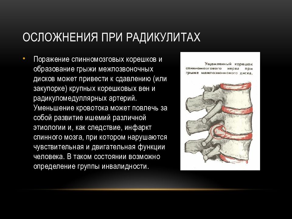 Что такое поражение. Осложнения пояснично крестцового радикулита. Радикулит презентация. Последствия радикулопатии.