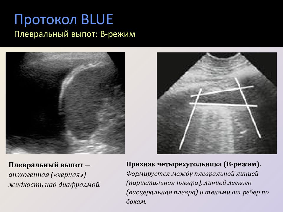 Узи плевральной полости. УЗИ плевральных полостей плеврит. УЗИ плевральных полостей протокол. Протокол УЗИ легких и плевры. УЗИ плевральной полости протокол УЗИ.