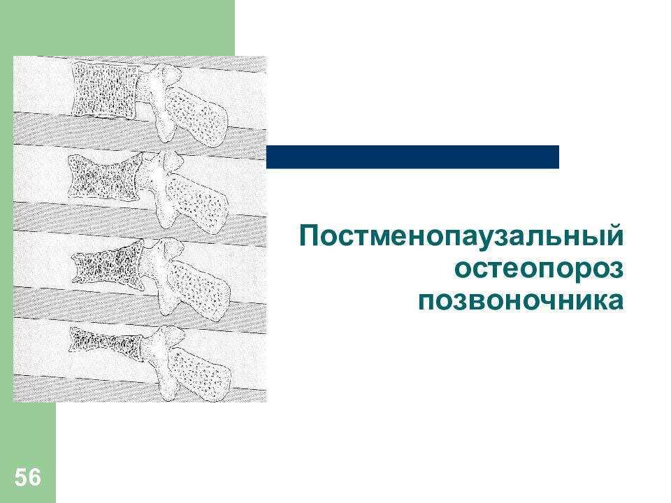 Постменопаузальный остеопороз презентация