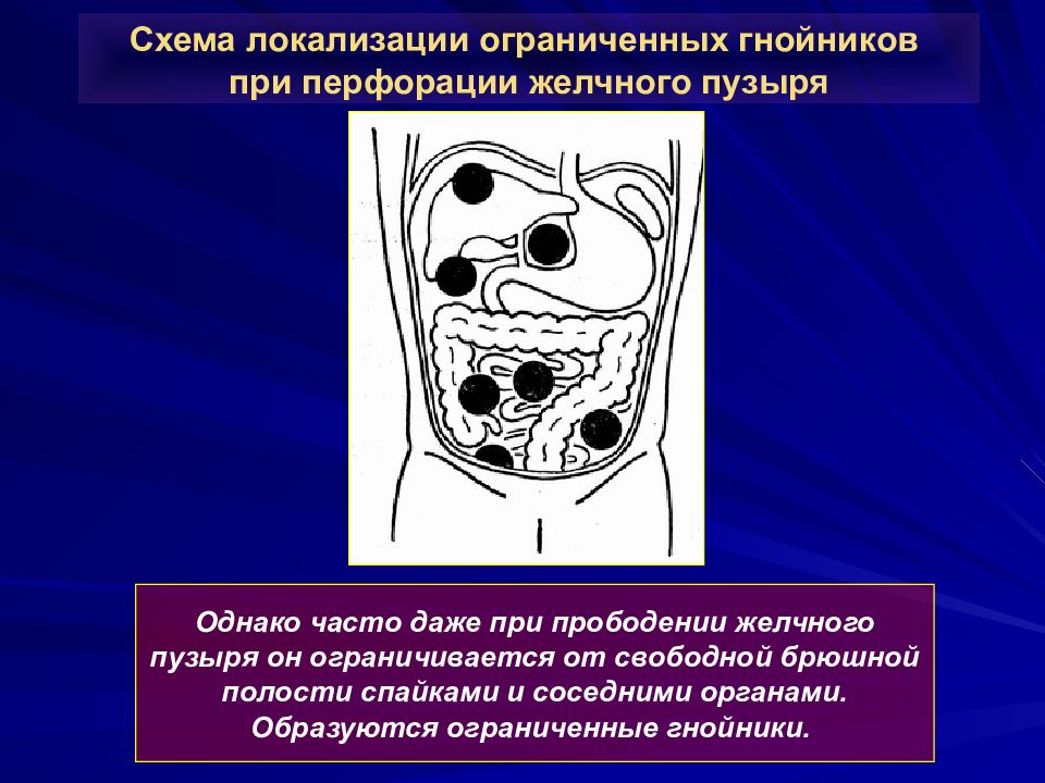 Смежные органы. Схема локализации гнойников лица. Перфорация желчного пузыря. Ограниченно локализованными