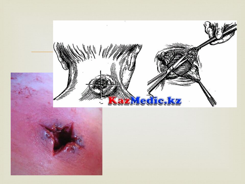Жұмсақ тіндердің іріңді процес стері. Suppurative processes of soft tissues