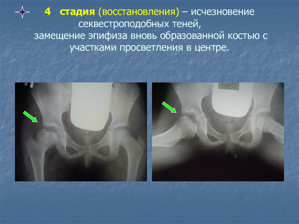 Болезнь пертеса презентация