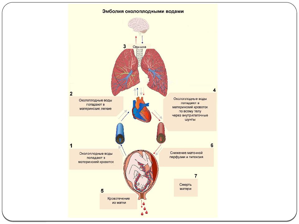Эмболия околоплодными водами презентация