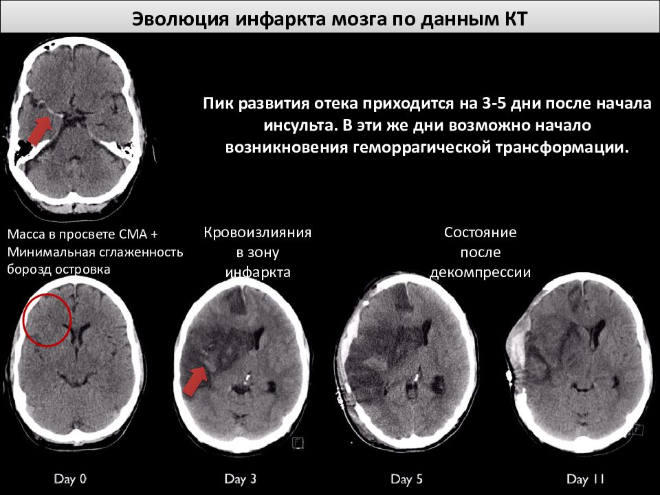 Стадии ишемии головного. Геморрагический инсульт головного мозга кт. Ишемический и геморрагический инсульт на кт. Хроническая стадия ишемического инсульта кт. Ишемический инсульт стадии по кт.