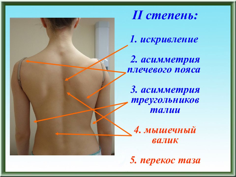 Правое плечо выше другого. Сколиоз мышечный валик. Асимметрия треугольников талии. Асимметрия плечевого пояса. Искривление плечевого пояса.