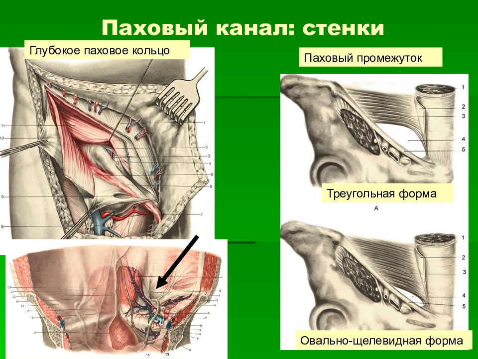 Паховая связка топографическая анатомия. Строение пахового канала топографическая анатомия. Стенки пахового канала топографическая. Глубокое паховое кольцо анатомия.