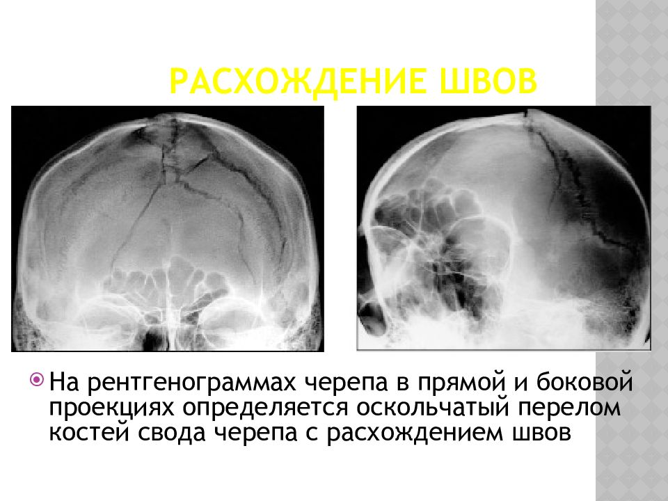 Сосудистый рисунок костей свода черепа усилен