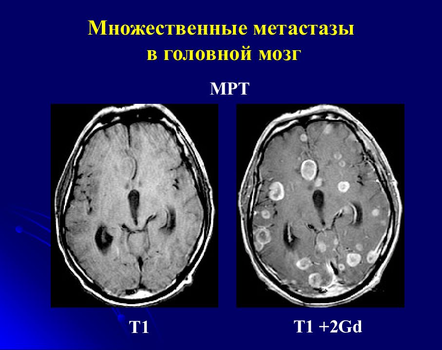 Метастазы в голове. Метастазы головного мозга кт кт. Кт диагнозы опухоль головного мозга. Метастазы в головном мозге на кт. Метастазы в головной мозг СКТ.