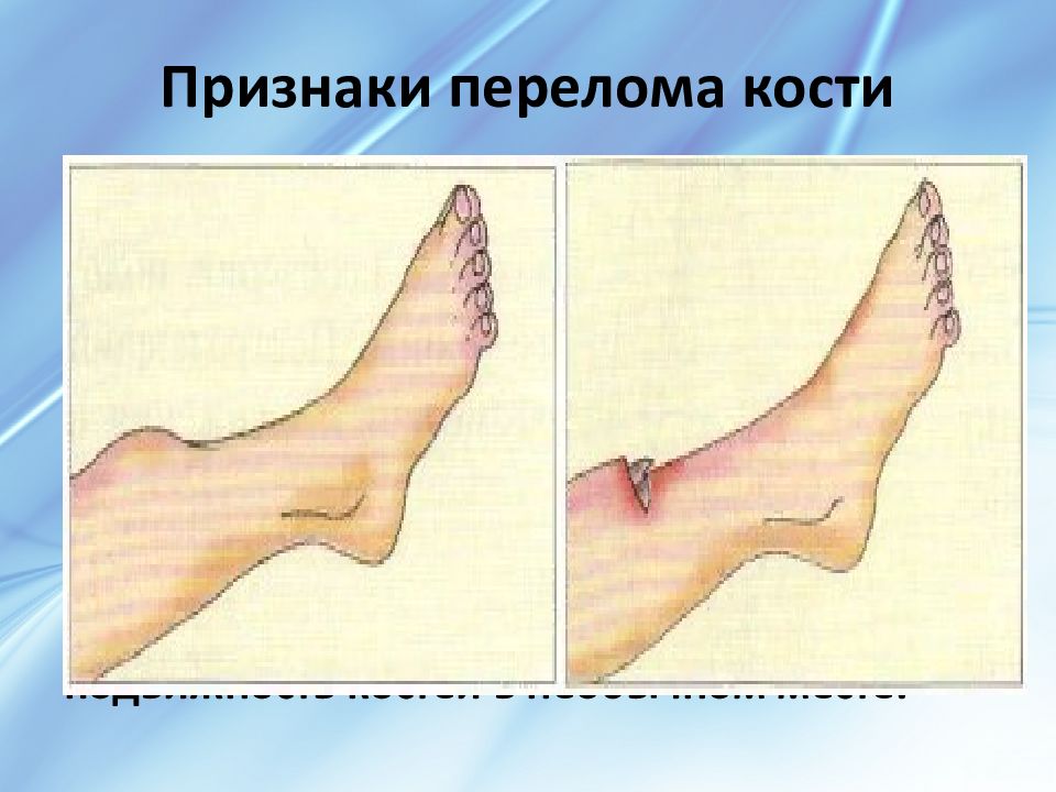 Признаки перелома костей. Местные признаки перелома. Прямые признаки перелома костей. Какие признаки что в кости трещина. Признаки перелома кулака.