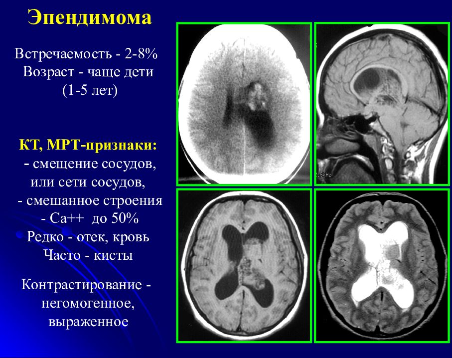 Мрт признаки. Эпендимома мозжечка мрт. Эпендимома IV желудочка на мрт. Эпендимома головного мозга кт.