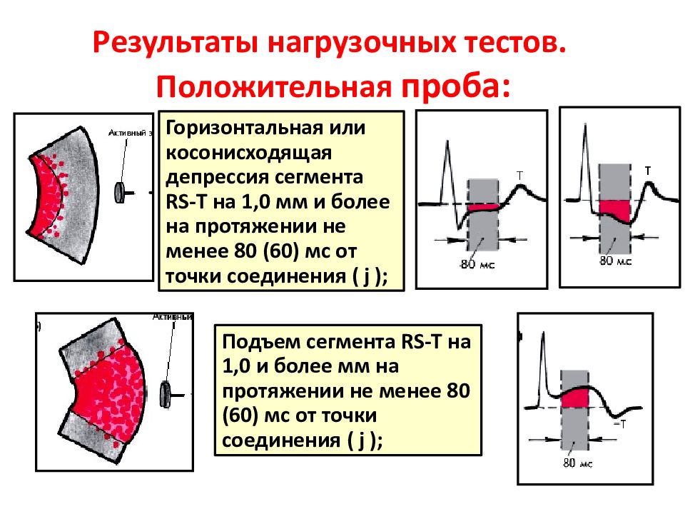 Косонисходящая депрессия сегмента