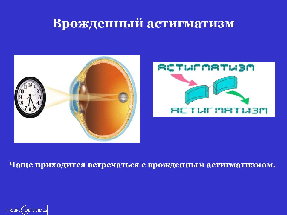 Сложный гиперметропический астигматизм глаз. Врожденный астигматизм. Врождённый астегматизм. Врожденный астигматизм лечится. Астигматизм презентация.
