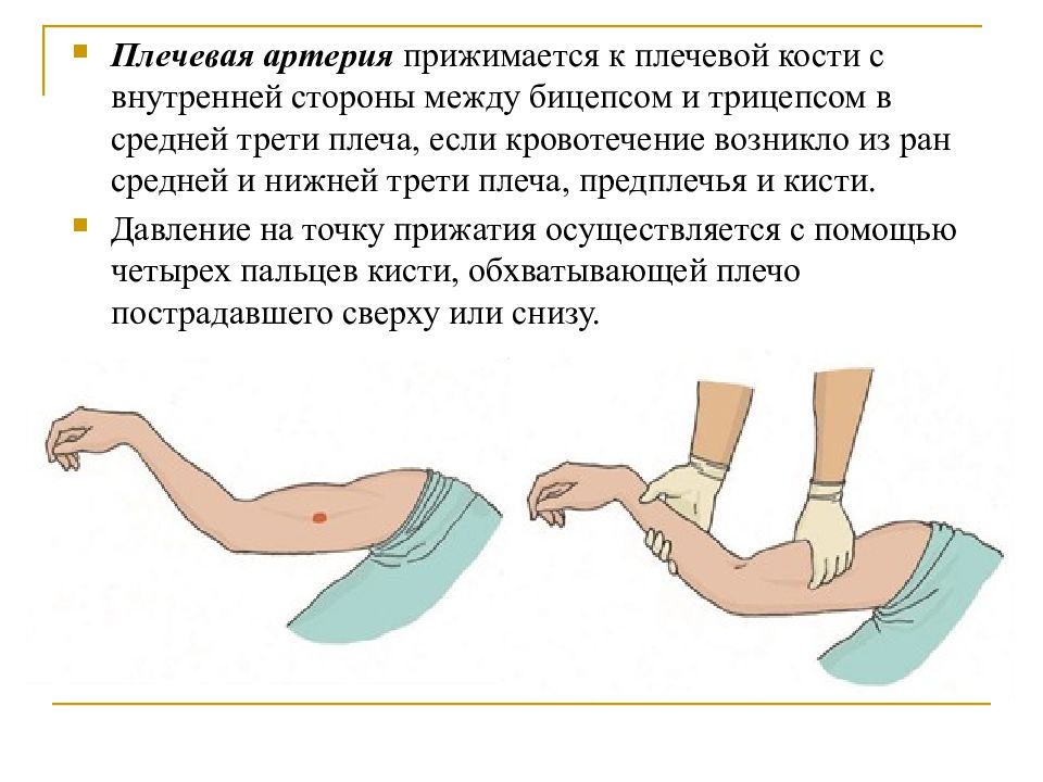 Кровотечение плеча. Кровотечение плечевой артерии. Кровотечение нижняя треть плеча. Плечевое артериальное кровотечение. Остановка кровотечения из плечевой артерии.