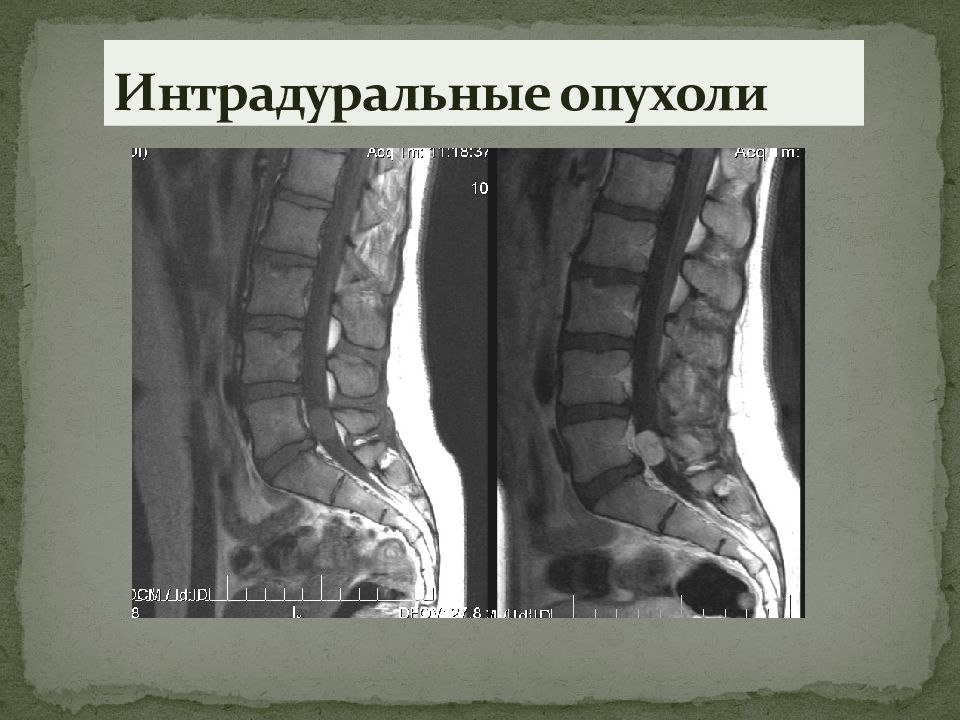 Опухоли спинного мозга презентация