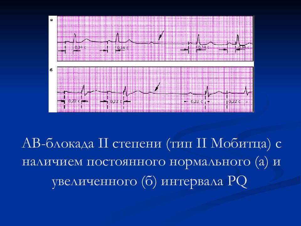 Презентация нарушение ритма и проводимости у детей