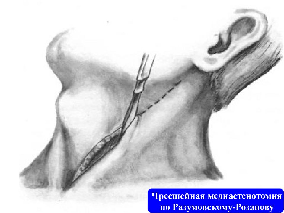 Хирургические заболевания пищевода презентация