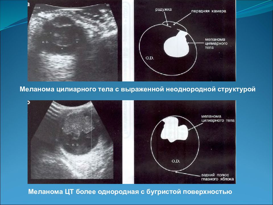 метастазы опухоли в печень на узи. метастазы в лимфатические узлы узи. узи меланомы. методы проведения исследования узи. лимфоузлы злокачественные на узи.