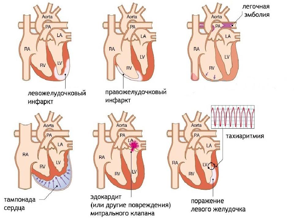 Кардиогенный шок варианты клиническая картина диагностика неотложная терапия