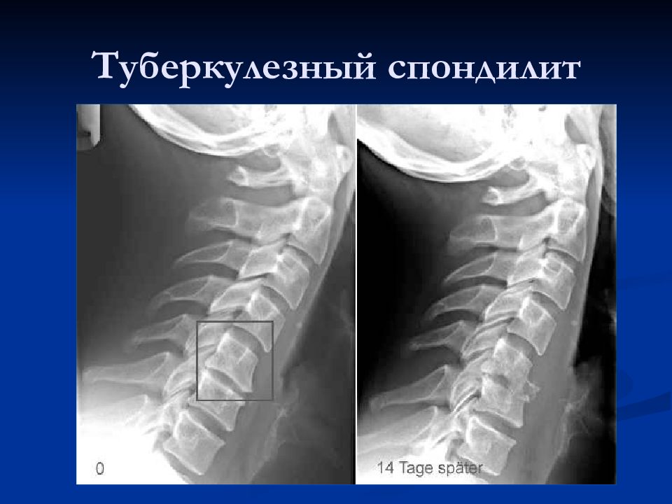 Туберкулез позвоночника презентация