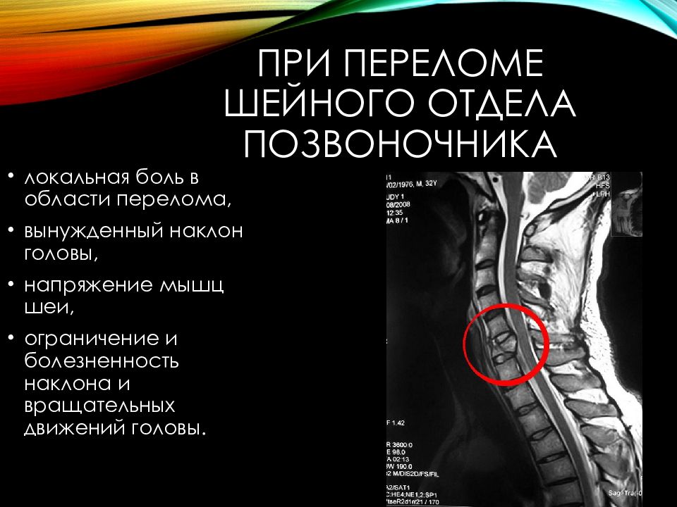 Переломы шейного отдела позвоночника презентация