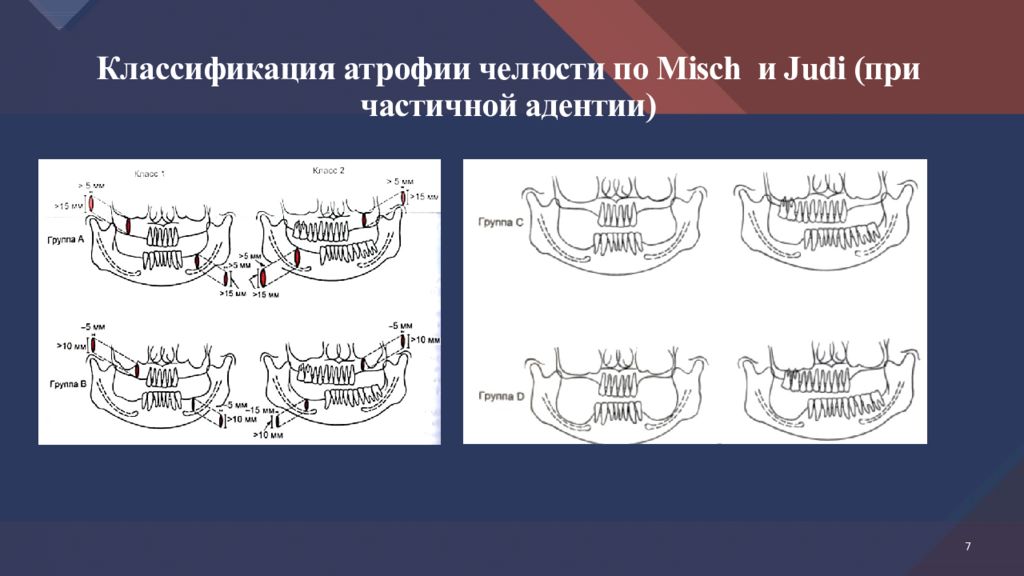 Альвеолярный гребень нижней. Классификация атрофии челюстей. Классификация атрофии челюстей по Misch Judi. Классификация частичной адентии. Классификация деформаций челюстей.