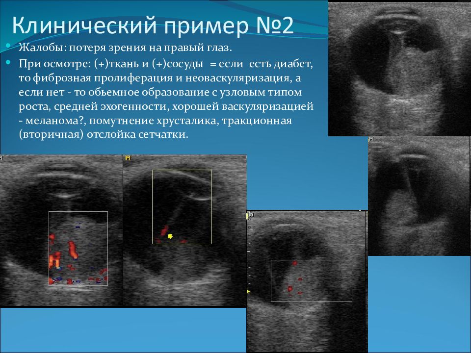 узи меланомы. метастазы в лимфоузлы на узи. дифференциальная диагностика меланомы хориоидеи. ультрасонография кожи. узи меланомы.