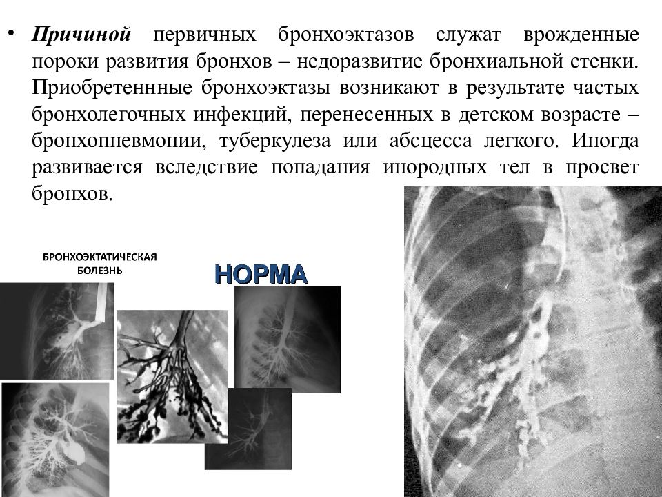 Бронхоэктатическая болезнь клиническая картина