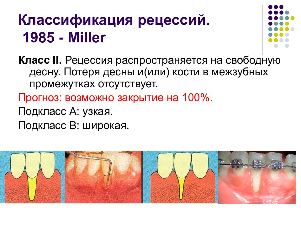 Классификация миллера. Классификация Миллера рецессии десны. Рецессия классификация Миллера. Классификация рецессии десны по Миллеру. Классификация Miller рецессия десны.