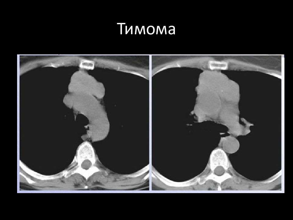 Тимома. Злокачественная тимома кт. Доброкачественная тимома. Тимома переднего средостения кт.