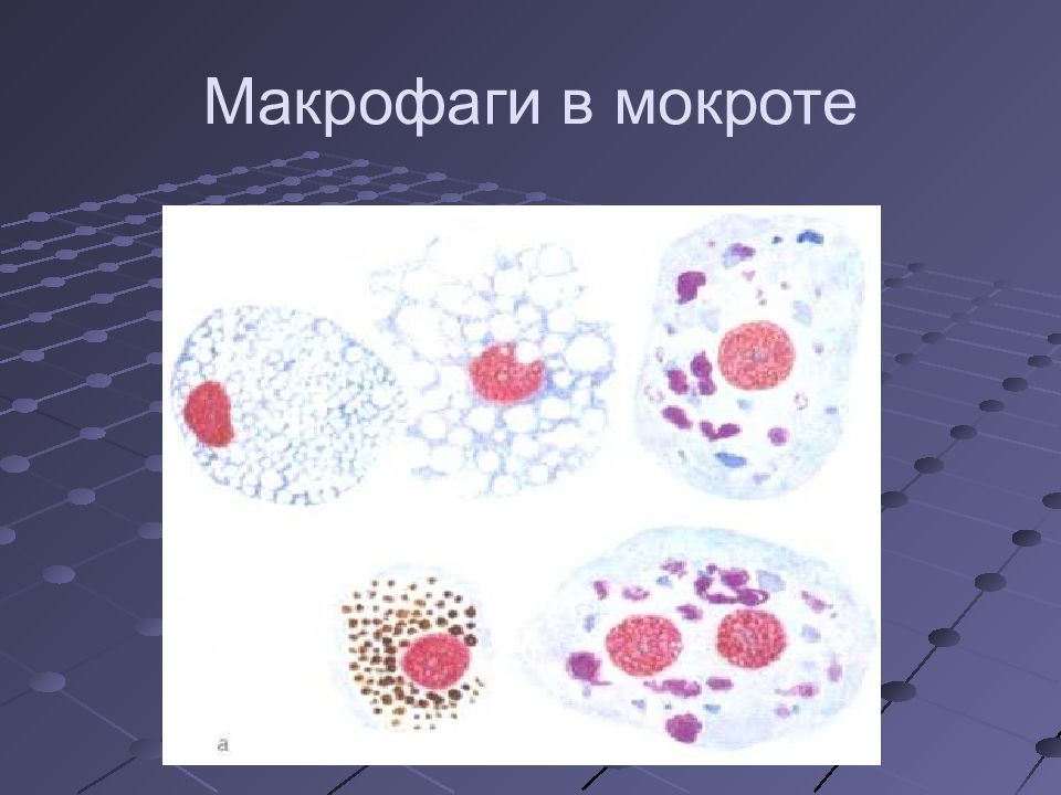 Макрофаги в мокроте. Альвеолярные макрофаги. Альвеолярные макрофаги в мокроте. Альвеолярные макрофаги курильщика.