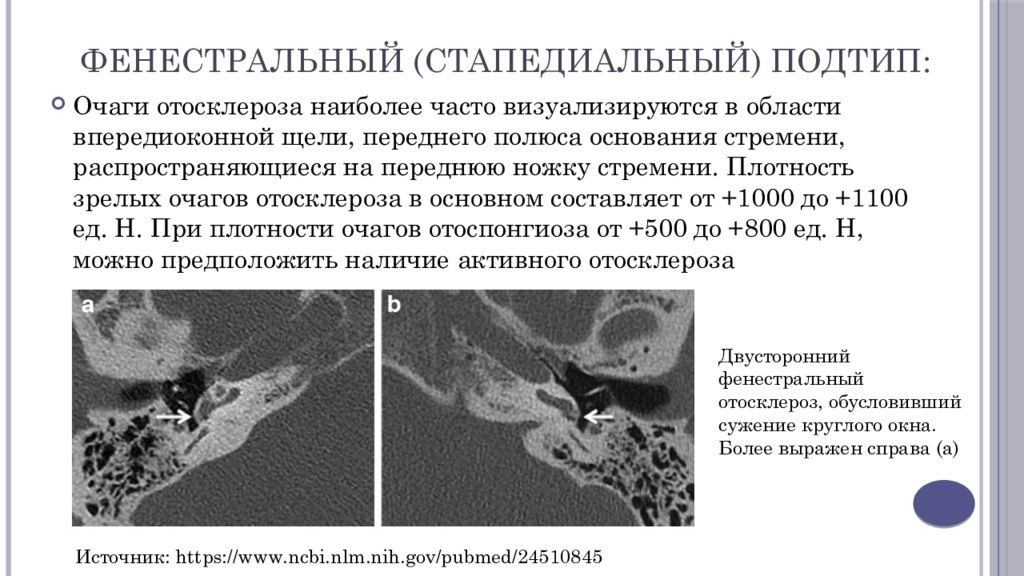 Отосклероз по утвержденным клиническим рекомендациям. Фенестральная форма отосклероза на кт. Фенестральный отосклероз на кт. Отосклероз на кт височных костей. Кт височных костей при отосклерозе.