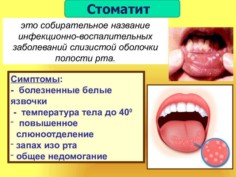 Презентация на тему галитоз