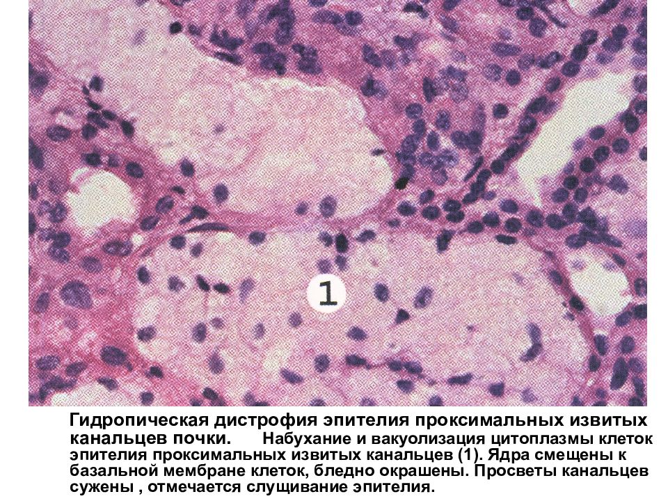 Зернистая дистрофия микроскопическая картина