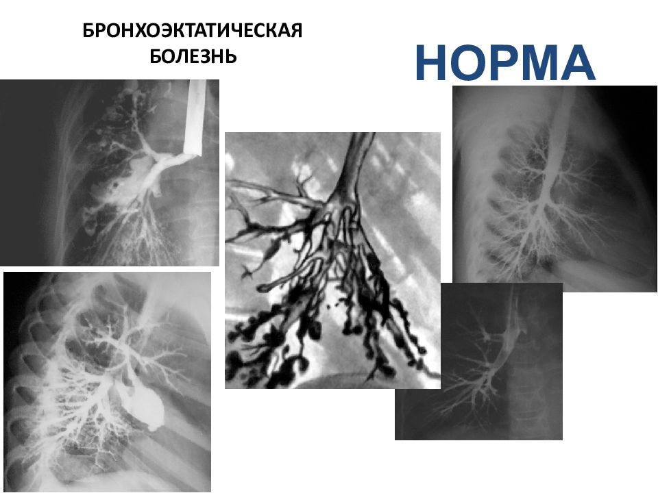 Клиническая картина бронхоэктатической болезни