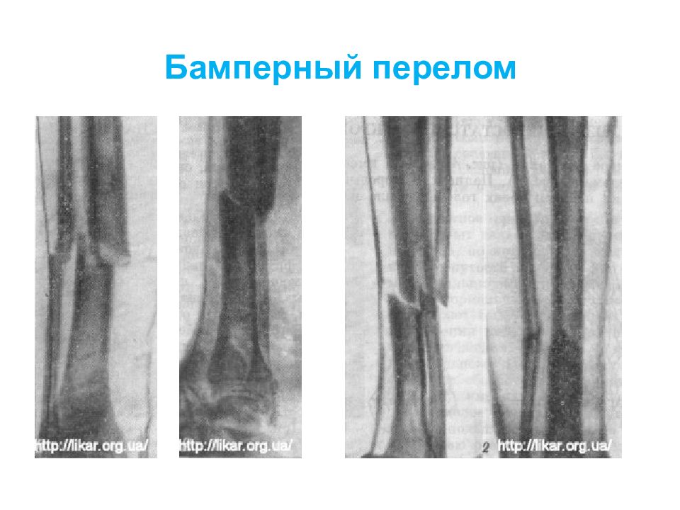 Презентация перелом костей голени