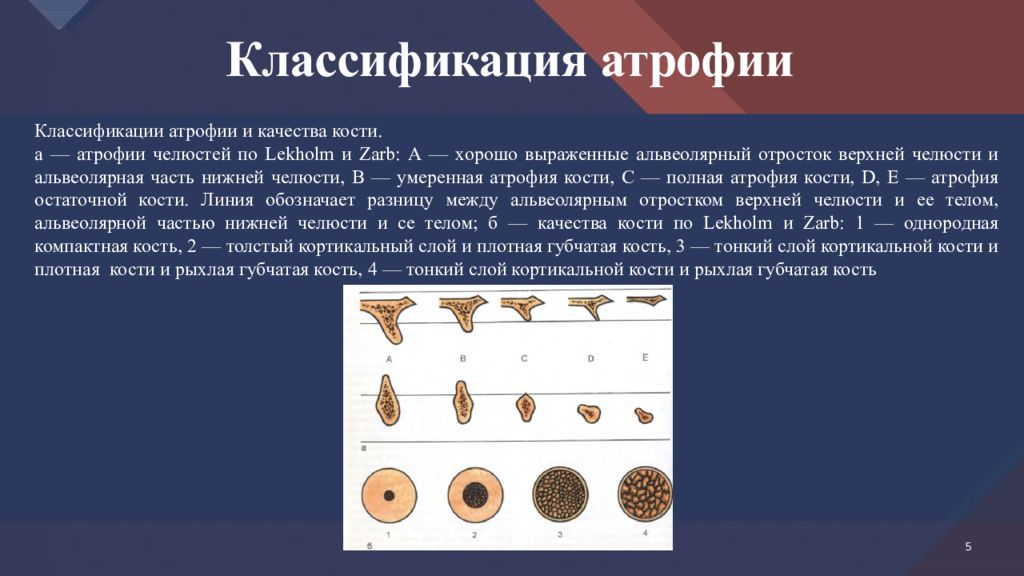 Атрофия альвеолярного отростка нижней челюсти