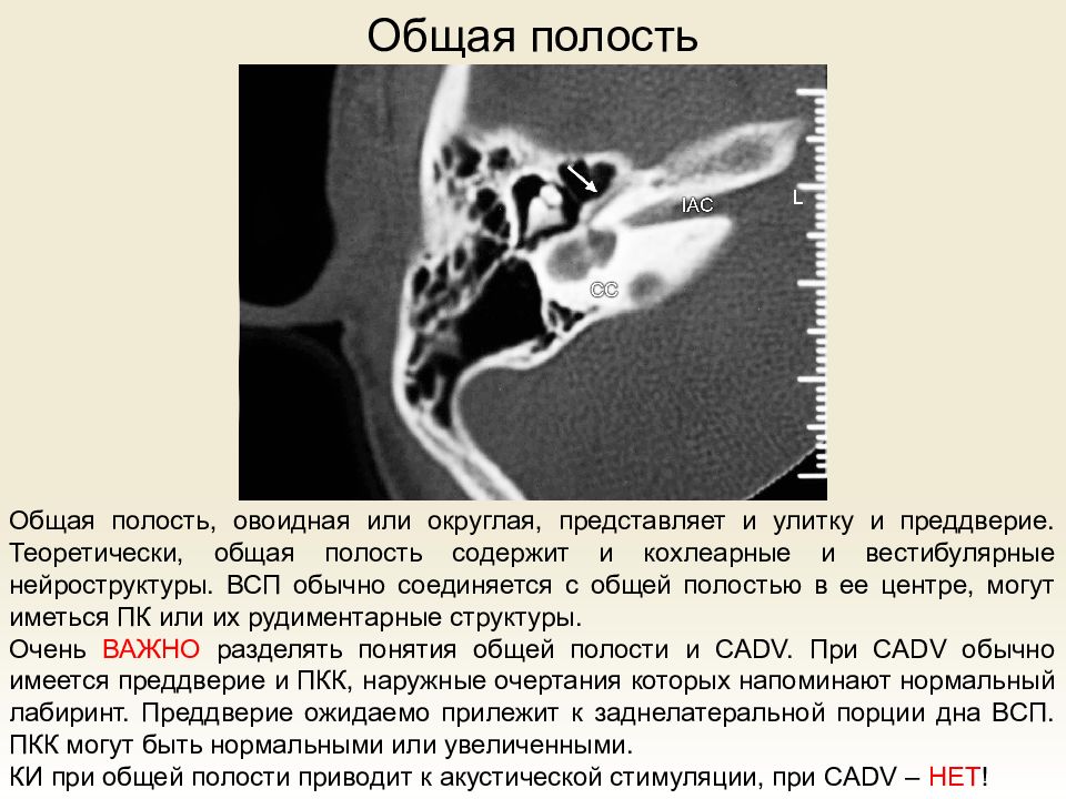 Средний отит кт картина