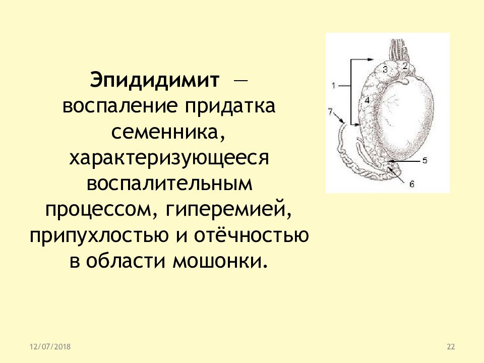 Лечение яичка. Воспаление придатка яичка. Эпидидимит придатка яичка. Эпидидимит воспаление яичка. Воспаление придатка семенника.