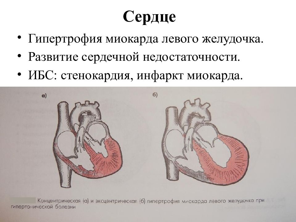 Гипертрофия миокарда рисунок