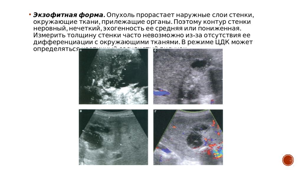 Опухоли желчного пузыря презентация