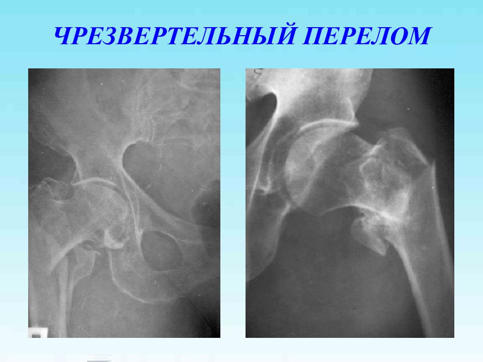 Чрезвертельный перелом. Чрезвертельный перелом шейки бедра. Чрезвертельный перелом шейки бедра рентген. Бедренная кость перелом чрезвертельный. Чрезвертельный перелом бедренной кости рентген.